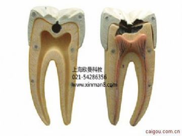 磨牙蛀牙解剖放大模型